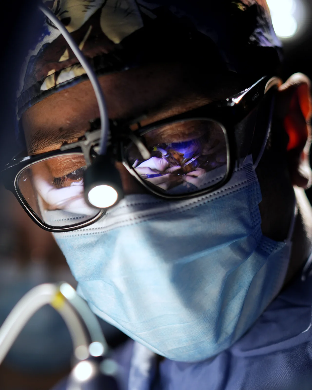 Dr. Santiago Chaves, cirujano maxilofacial, concentrado durante una cirugía con lupas y luz frontal